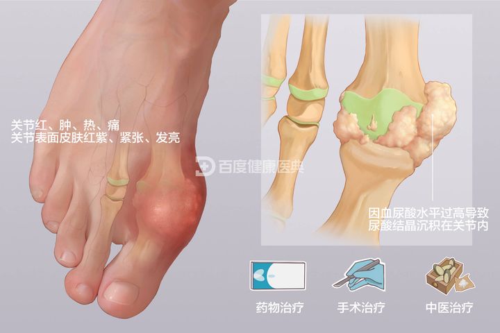痛风可以治愈吗